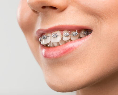 Beautiful young woman with teeth braces on gray
